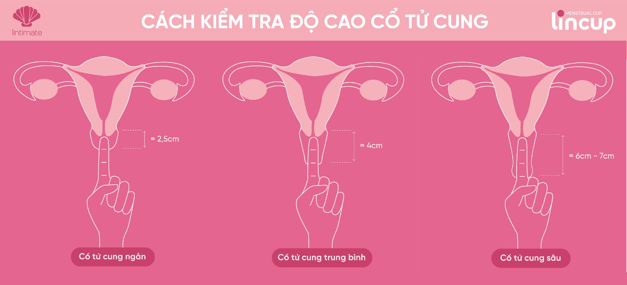 Vì sao bạn nên kiểm tra độ cao cổ tử cung trước khi sử dụng cốc nguyệt san?
